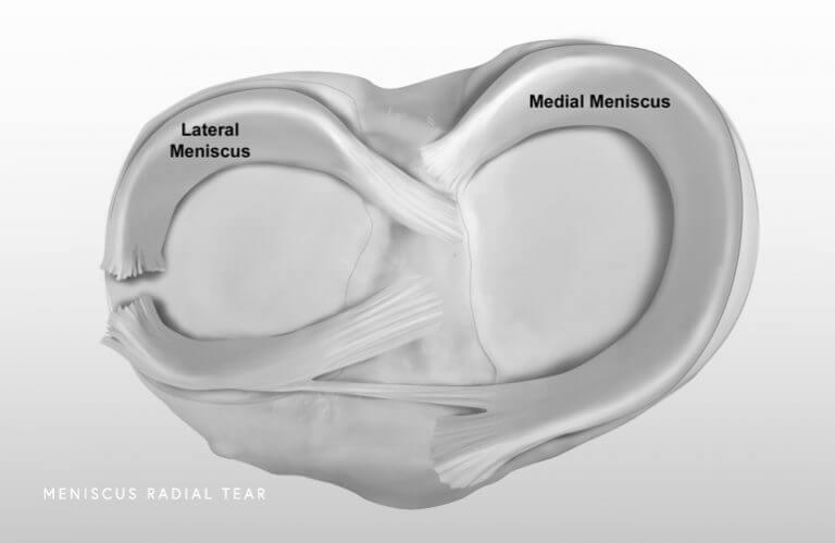 MCL Injury: Medial Collateral Ligament (MCL) Tear & Reconstruction, Knee  Surgeon in Mumbai